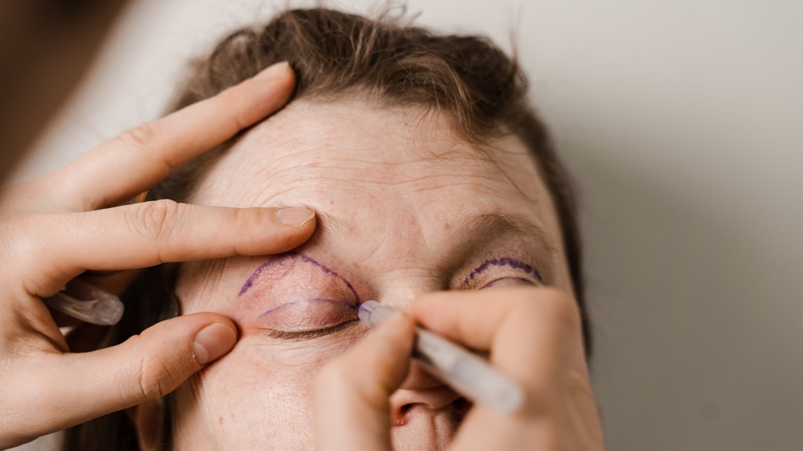 Cirurgia Plastica Ocular | COH