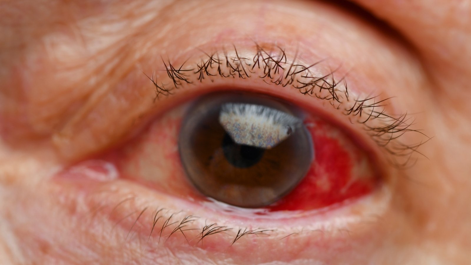 Injeção intravítrea | COH