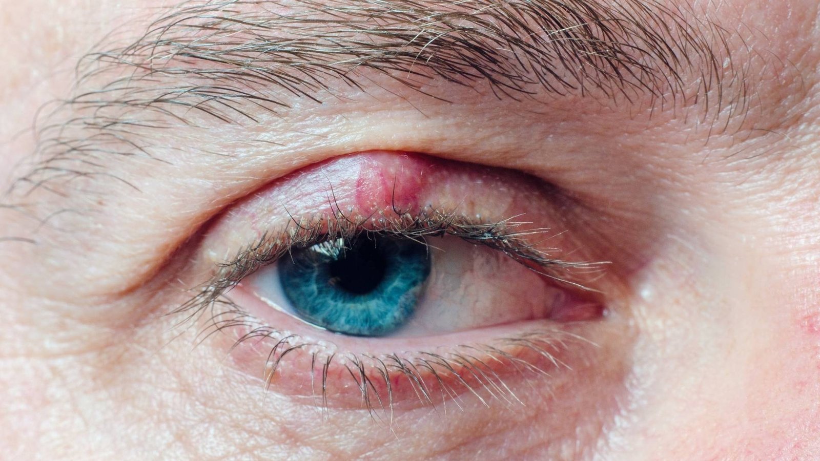 Calázio | Hospital de Olhos Vasconcelos Neto