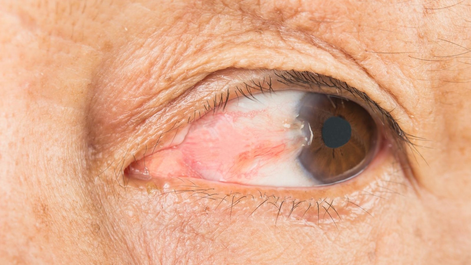 Capsulotomia YAG Laser | Hospital de Olhos Vasconcelos Neto