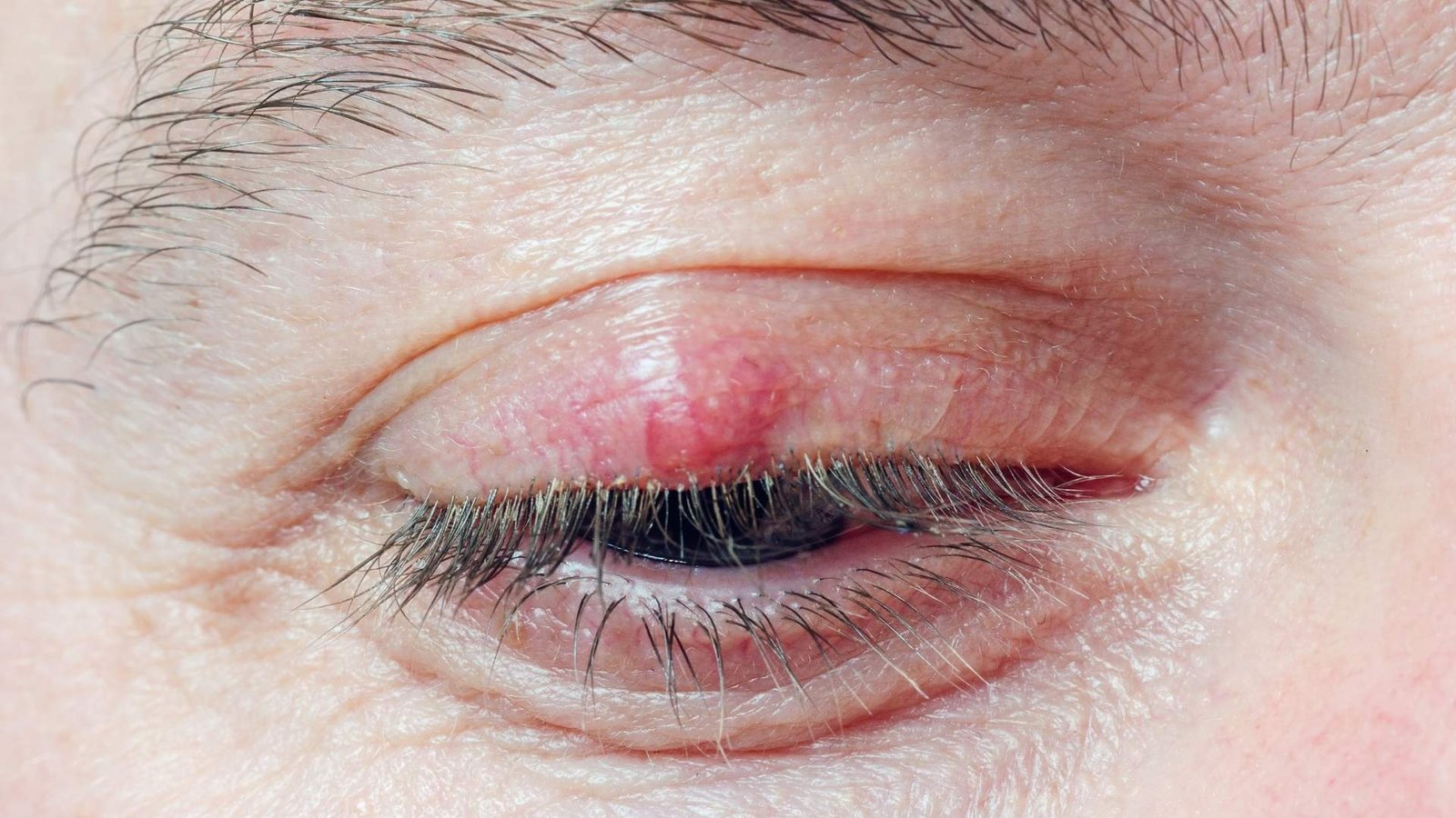 Tumor Palpebral | Hospital de Olhos Vasconcelos Neto